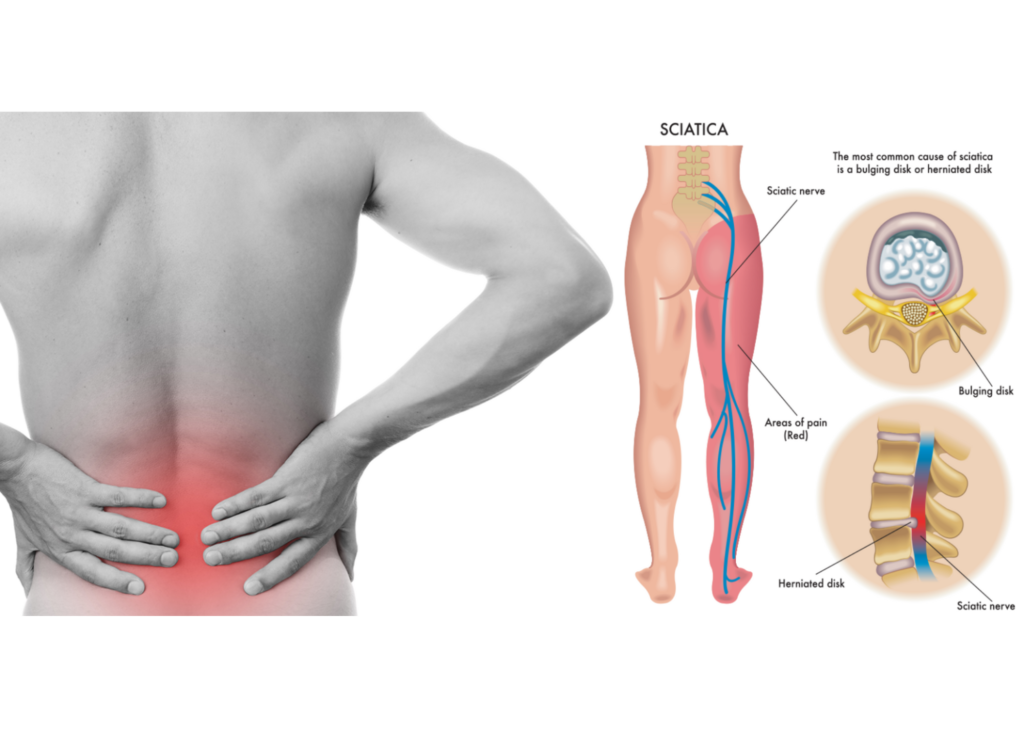 What is sciatic pain and how to avoid it