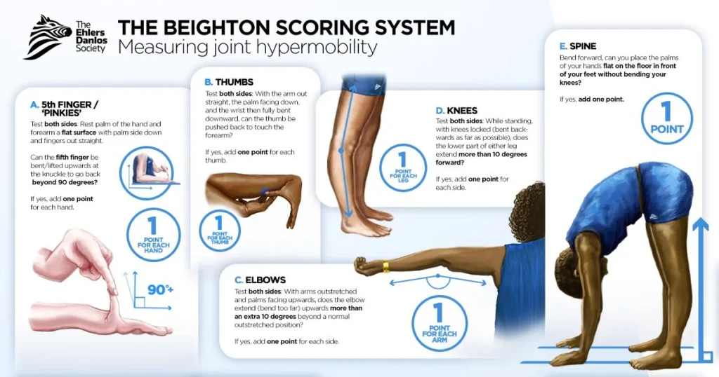 Beighton Score Infographic_ Salinas PT